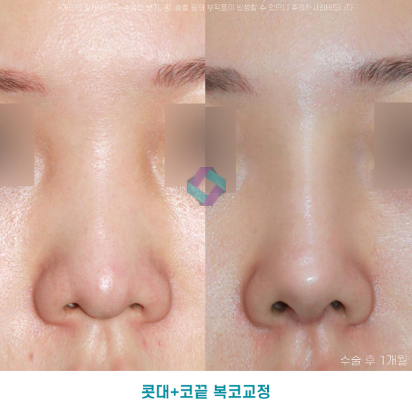 낮은코성형후기 참고하고 상담할때 관련 이미지 3