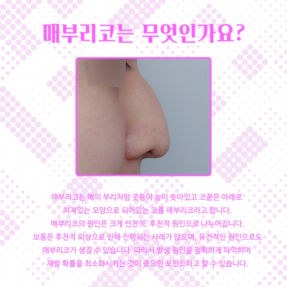 Women’s Hump Nose: The Hump Should Be Cleanly Removed image 3