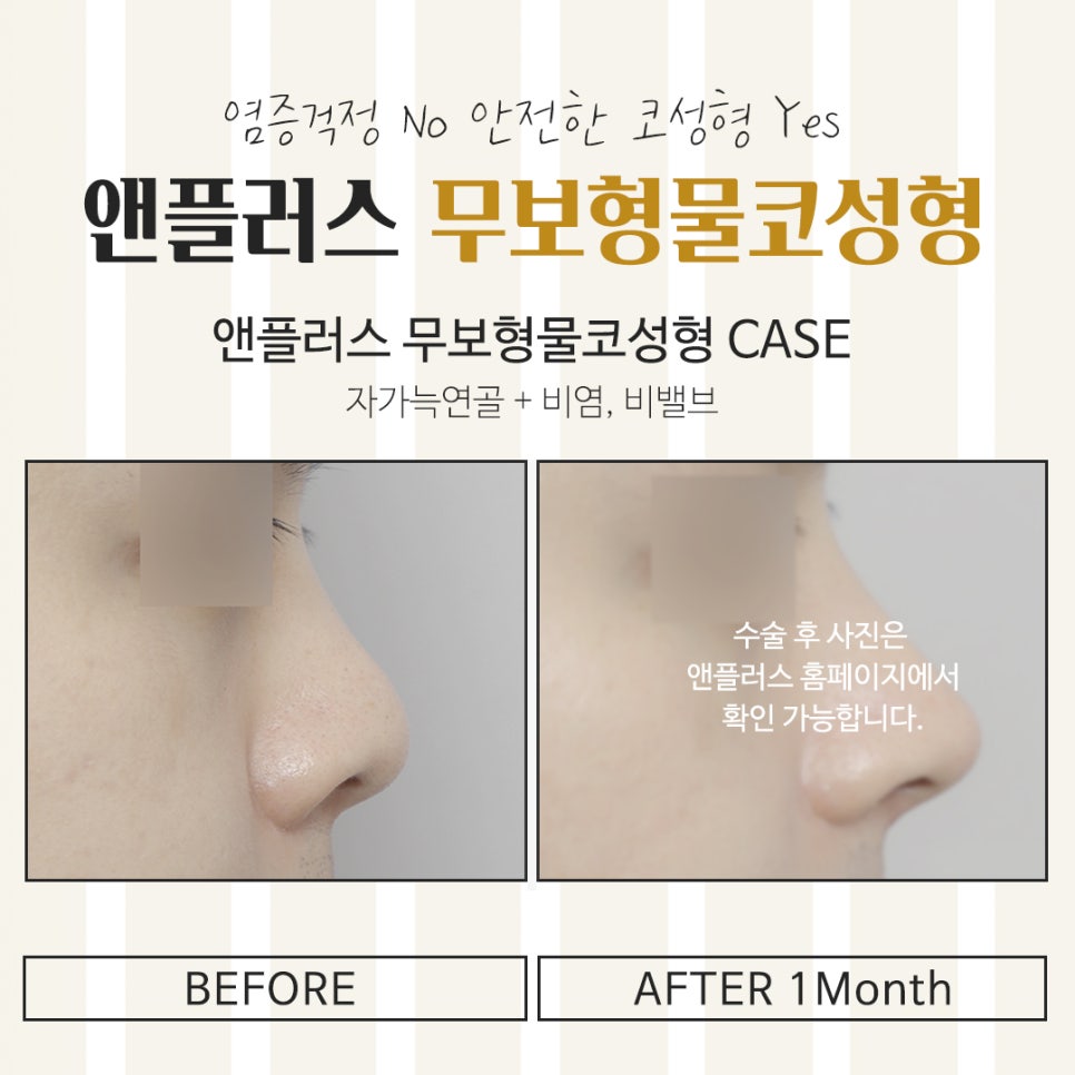 무보형물코수술후기 다양한 내용을 알아보고 관련 이미지 14