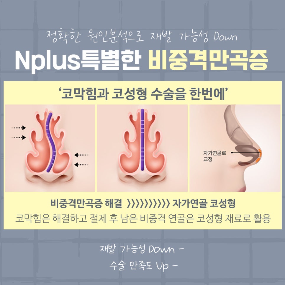 비중격만곡증수술 후기까지 확인하여 관련 이미지 10