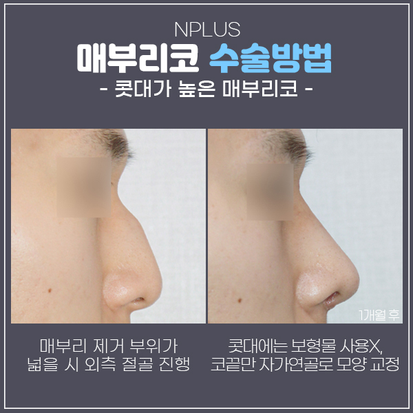 Improving Both the Function and Appearance of a Hump Nose in Men image 5
