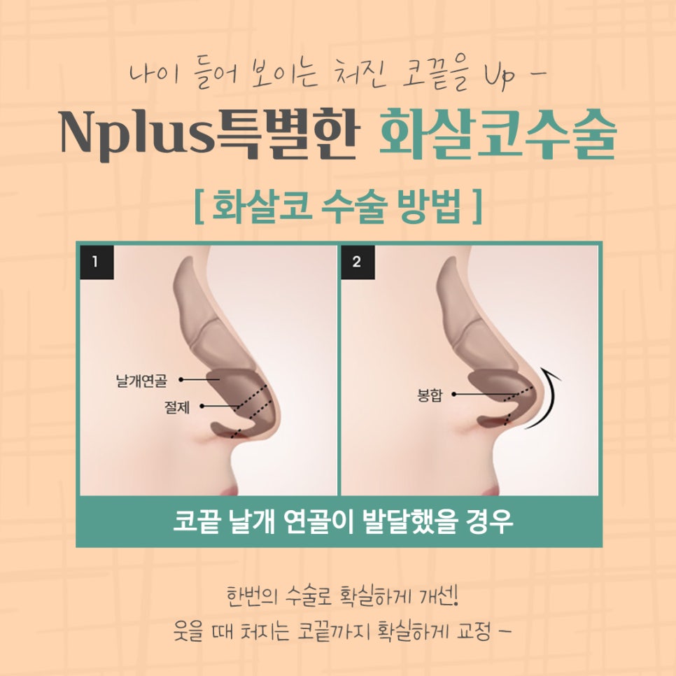 화살코수술 후기까지 알아보고 결정 관련 이미지 9