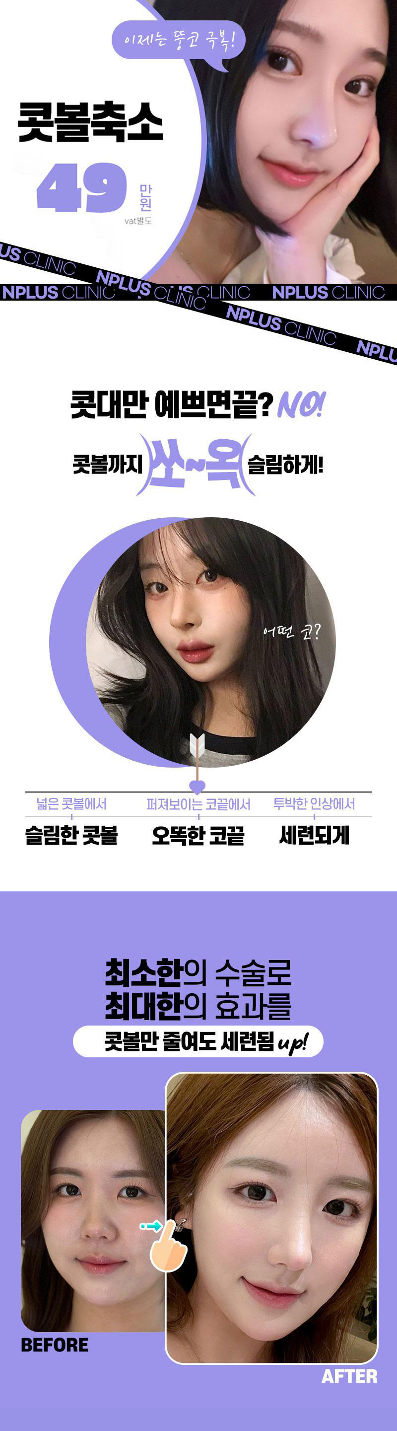 앤플러스에서 진행하는 콧볼축소 이벤트! 관련 이미지 2