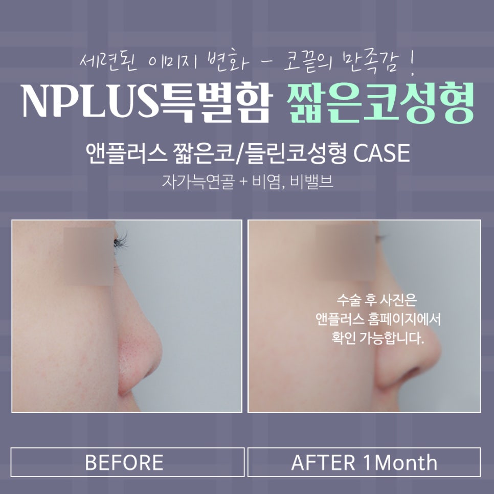 짧은코성형 후기를 보고 개선된 점 알아보기 관련 이미지 15