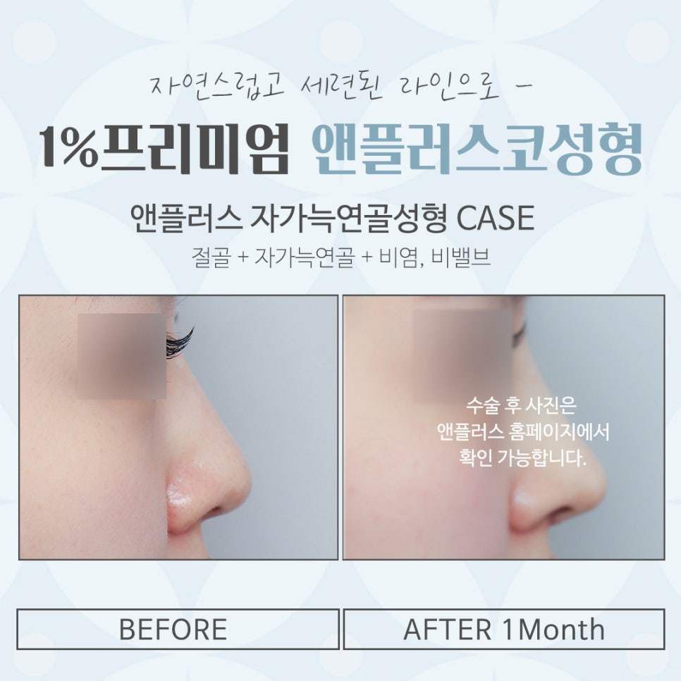 늑연골코수술 내용을 확인해 보고 관련 이미지 15