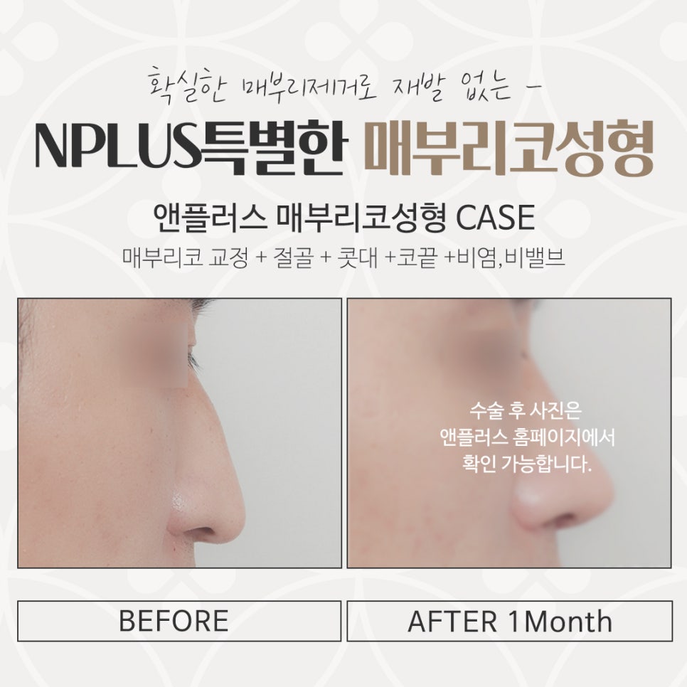 Checking a Hump Nose Surgery Review in Various Ways image 16