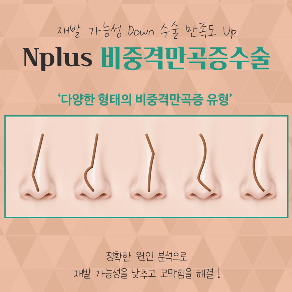 비중격만곡증수술 꼼꼼하게 알아보고 관련 이미지 6