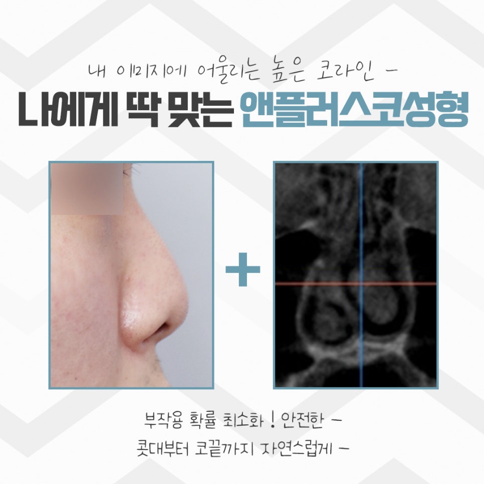 Rhinoplasty Review: Improved with a Refined Line image 5