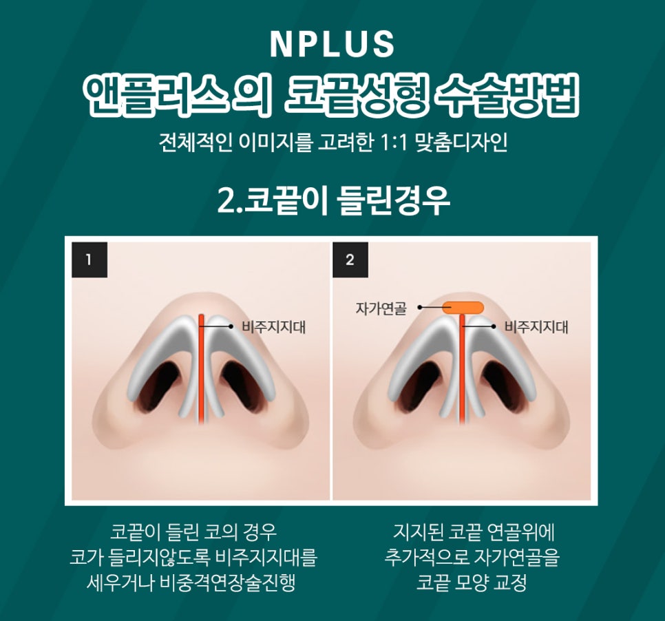 A Detailed, Careful Review of Tip Rhinoplasty image 6