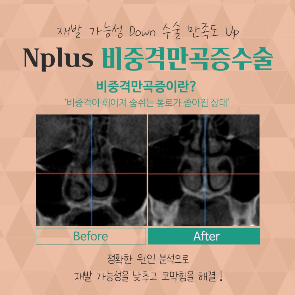 비중격만곡증수술 꼼꼼하게 알아보고 관련 이미지 3