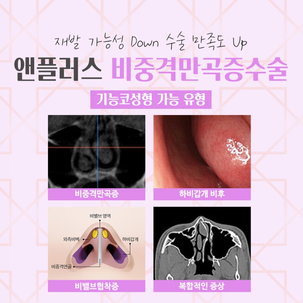 비중격만곡증수술후기 원인과 해결 방법까지 관련 이미지 6