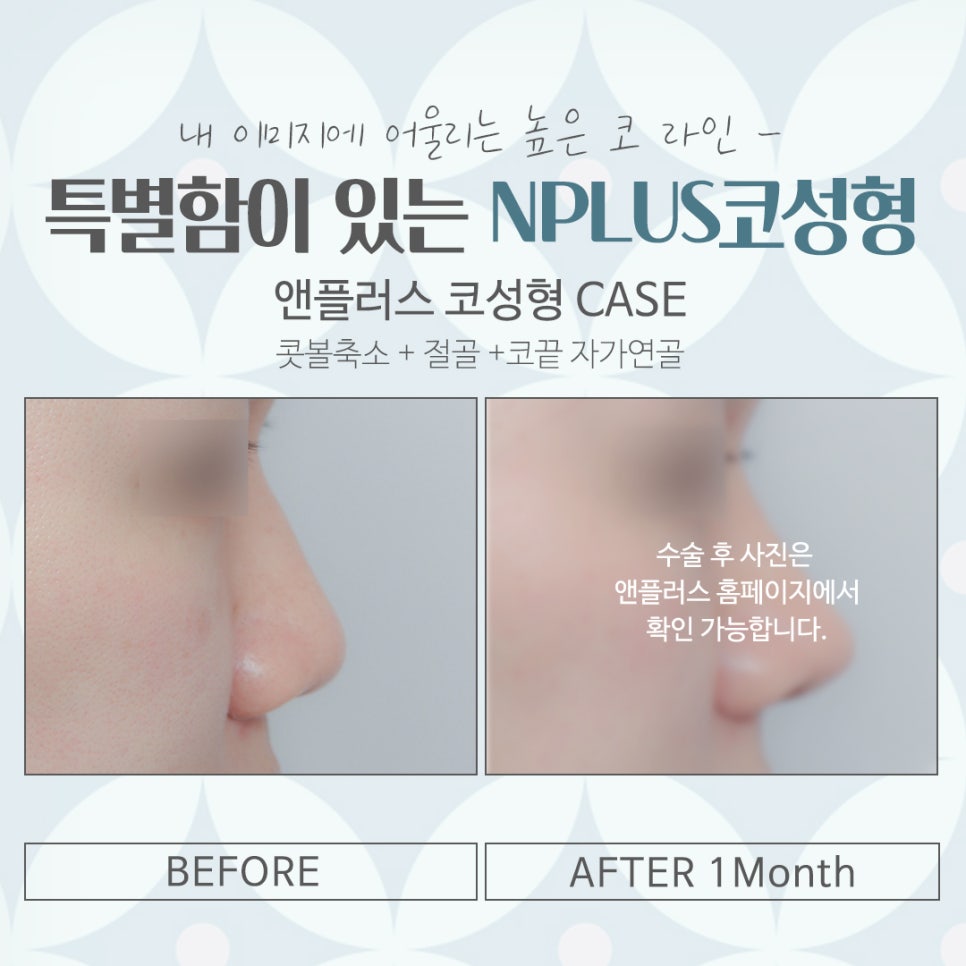 A Beautiful Nose Line at a Well-Known Seoul Plastic Surgery Clinic image 16