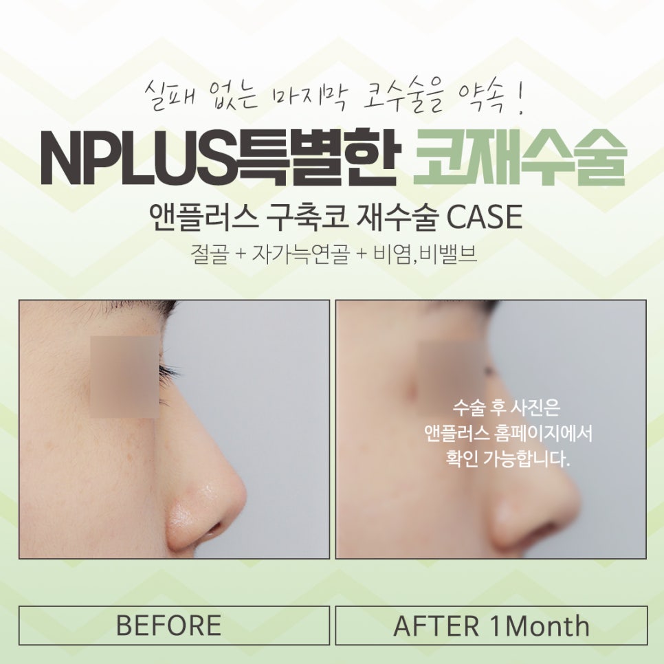 Looking at the Differences in Revision Rhinoplasty Reviews image 15