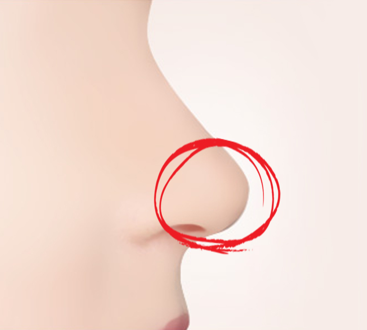코 성형 후 보형물을 빼도 원래대로 돌아갈까? 관련 이미지 2