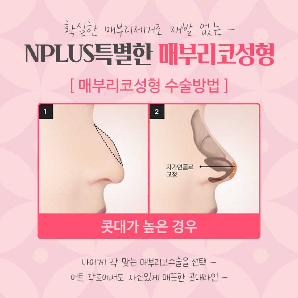 매부리코성형후기 내부까지 확인하고 관련 이미지 9
