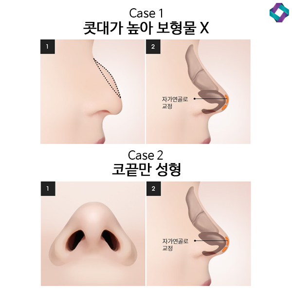 What to Know When Having Surgery Without an Implant Using Nasal Cartilage image 3