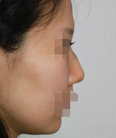 1_여자 매부리코 수술전후 관련 이미지 3