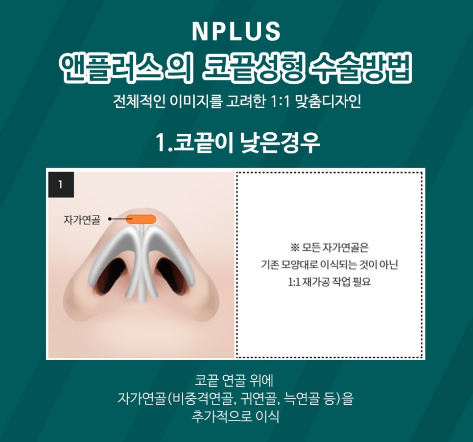 A Detailed, Careful Review of Tip Rhinoplasty image 5