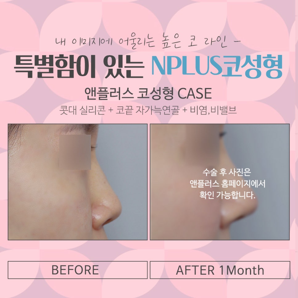 Nose Surgery Review with a Natural Nose Line image 16