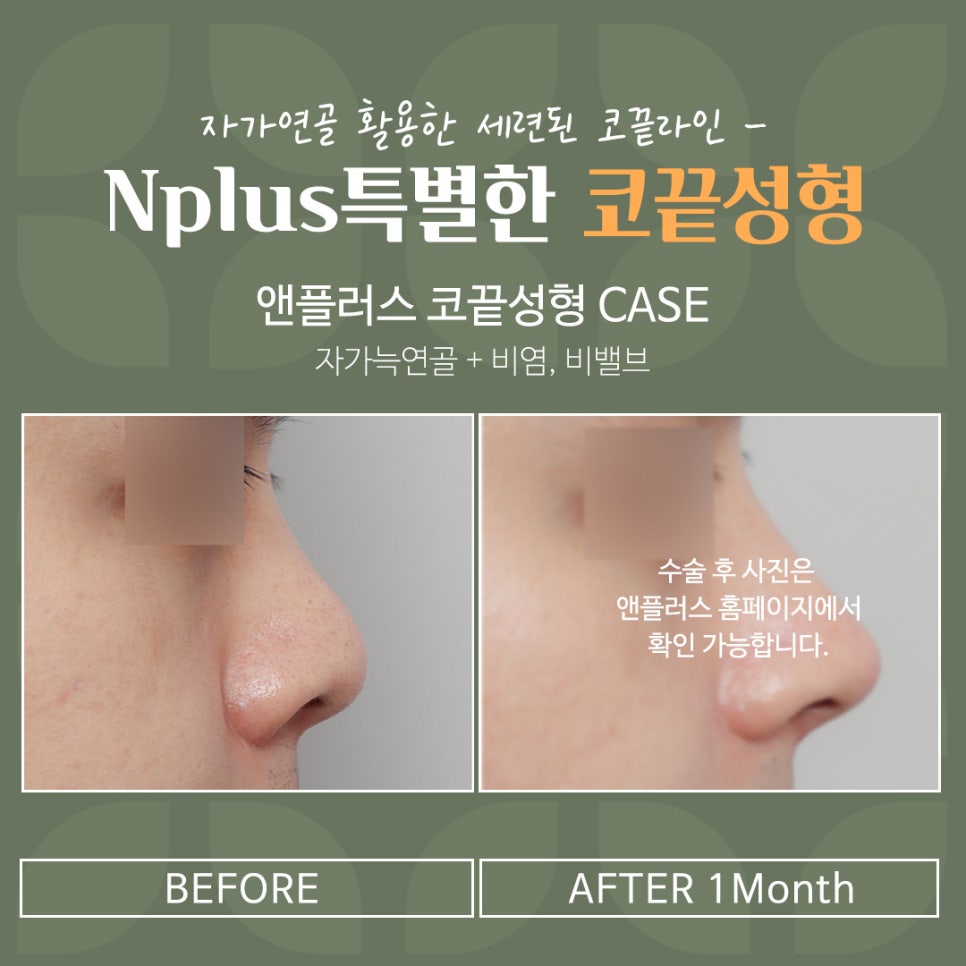 코끝성형으로 자연스럽게 예뻐지자 관련 이미지 15