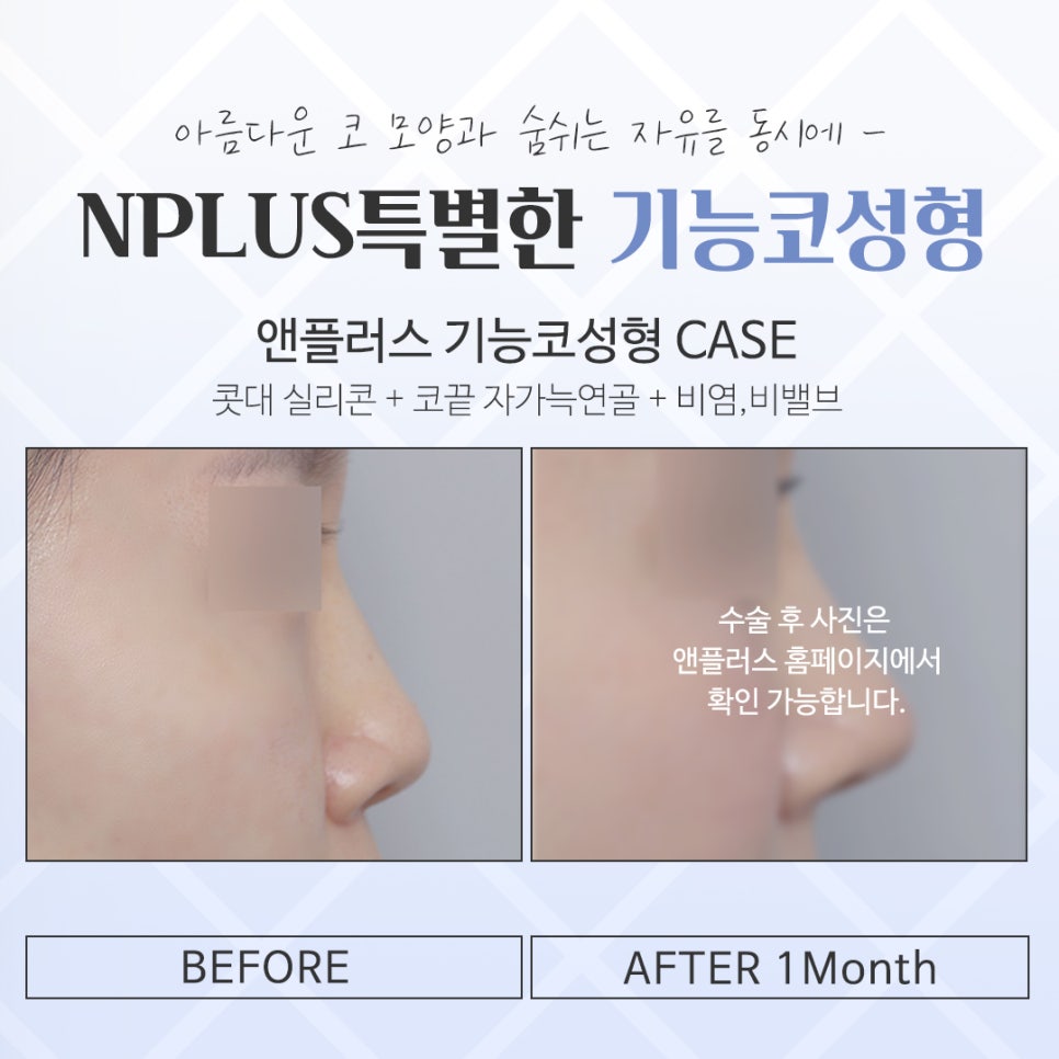 기능코성형 후기 보고 비교하여 관련 이미지 14