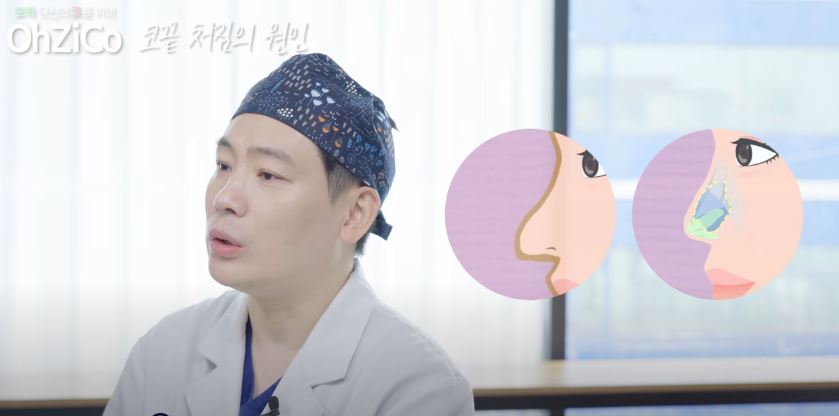 코성형 후 코끝처짐 원인과 해결 방법 관련 이미지 11