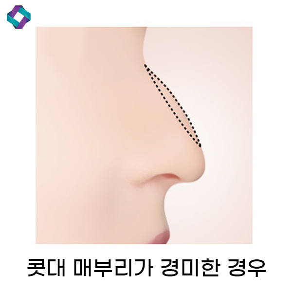 코수술 전후 비교, 앤플러스 매부리코에 대하여 관련 이미지 6