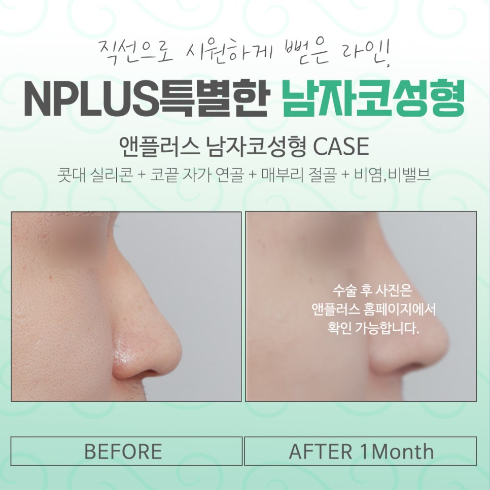 남자코수술후기를 자세하게 알아보고 관련 이미지 14