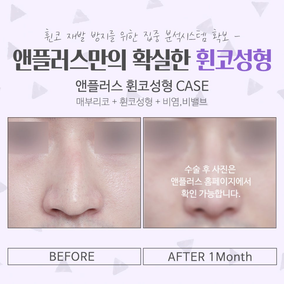 Bent Nose Surgery Review: With an Accurate Diagnosis image 16