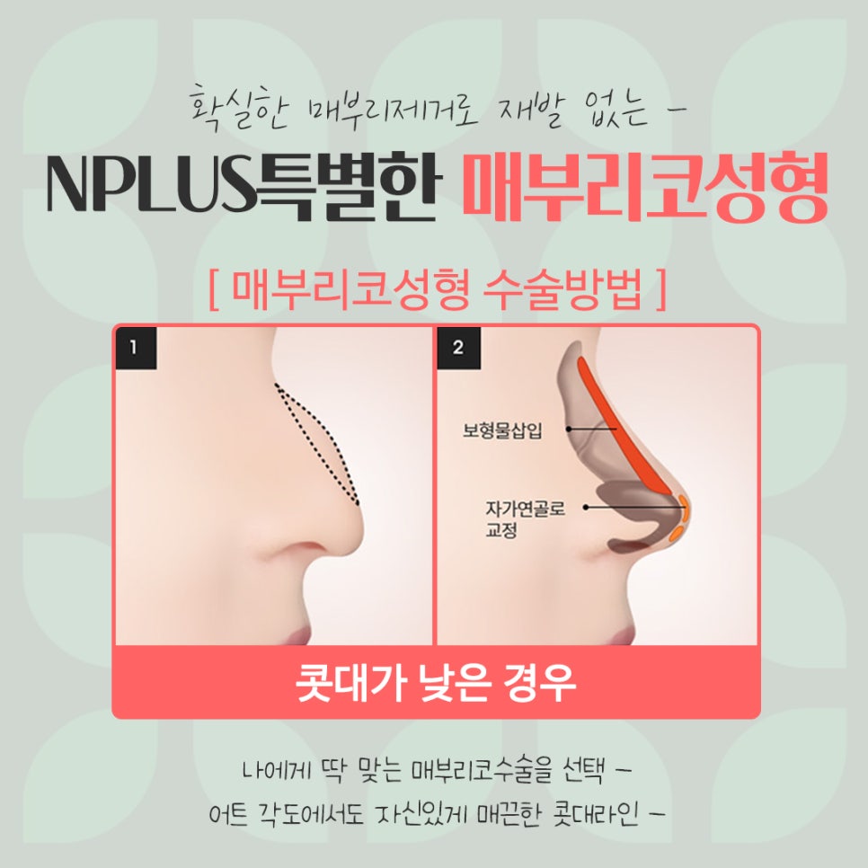 매부리코교정으로 부드러운 인상 관련 이미지 10