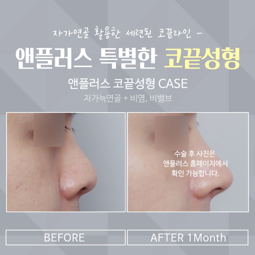 Tip Plasty Through Tip Cartilage Stitching image 16