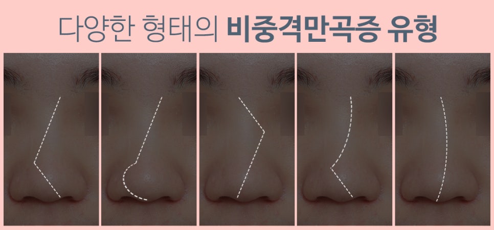 Septoplasty Surgery at N+ image 5