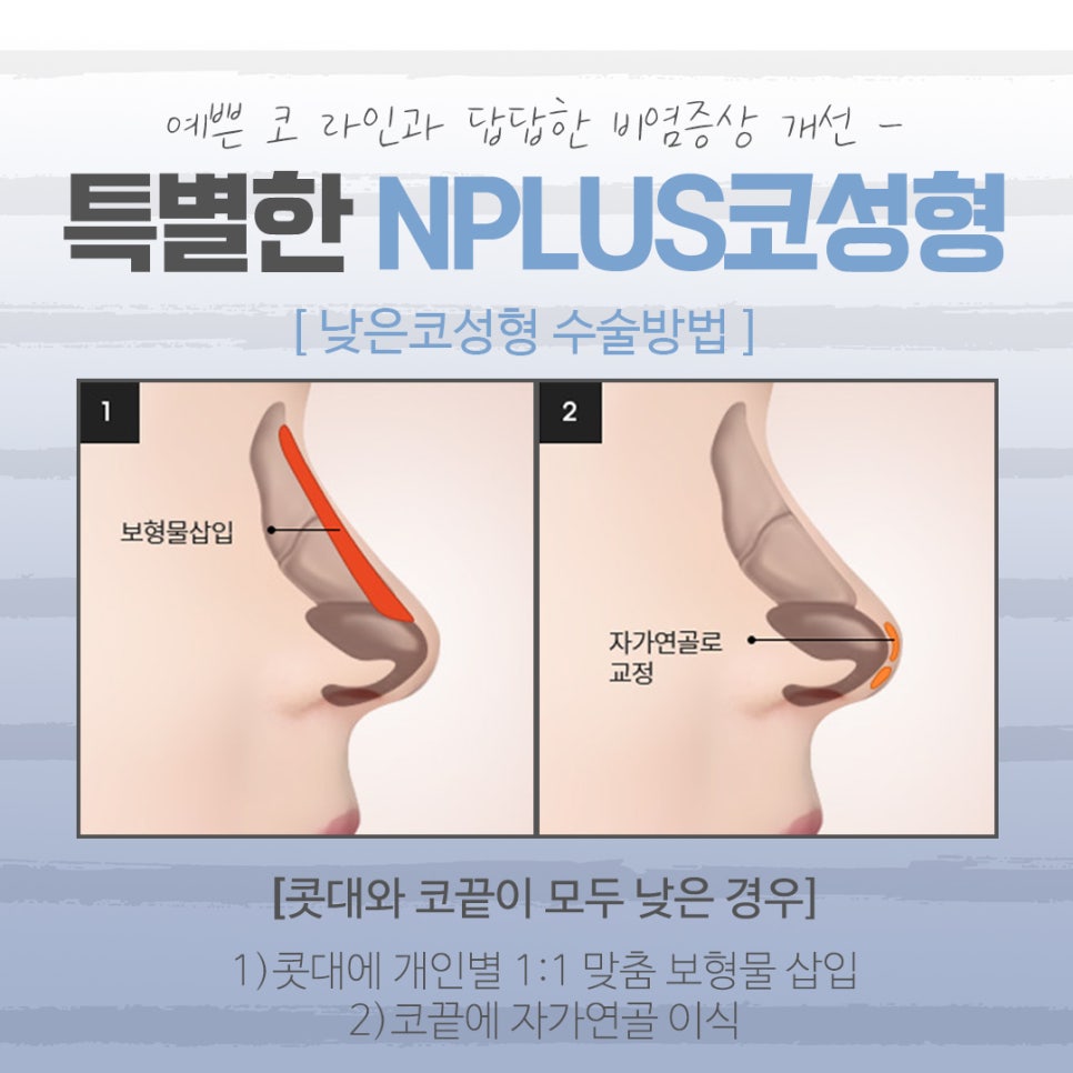 낮은코성형에 대해 꼼꼼하게 체크하고 관련 이미지 7