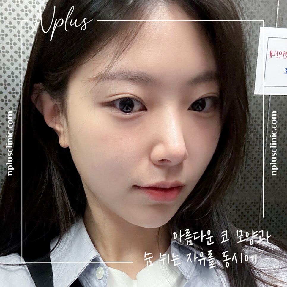 코성형후기 제대로 알아보고 관련 이미지 6