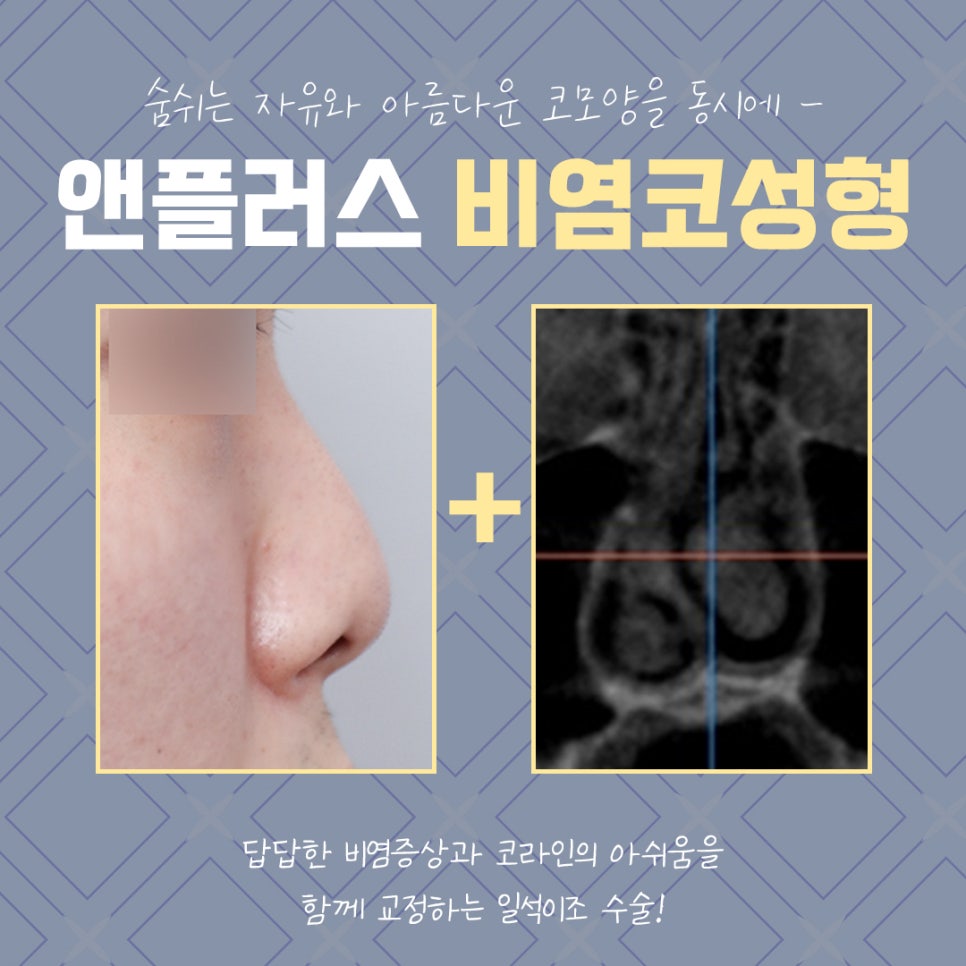 Review of Rhinoplasty for Rhinitis: Check and Decide image 4