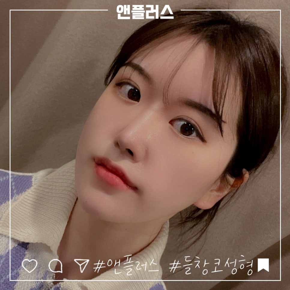 짧은코수술 후기까지 확실하게 관련 이미지 5