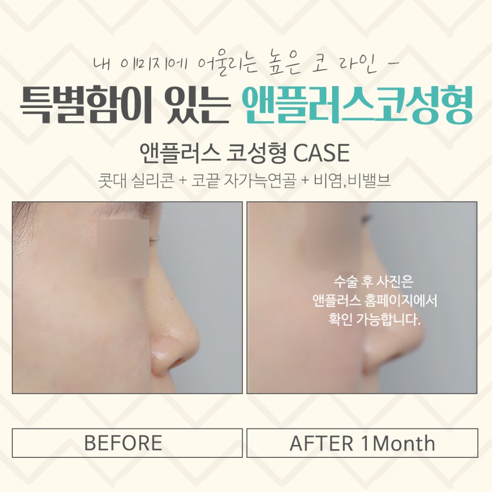 코수술후기 자세하게 알아보고 판단 관련 이미지 15