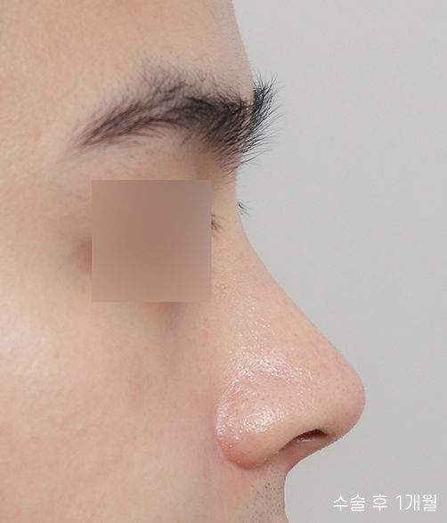 Natural and Satisfying Non-Implant Nose Surgery for Men image 2