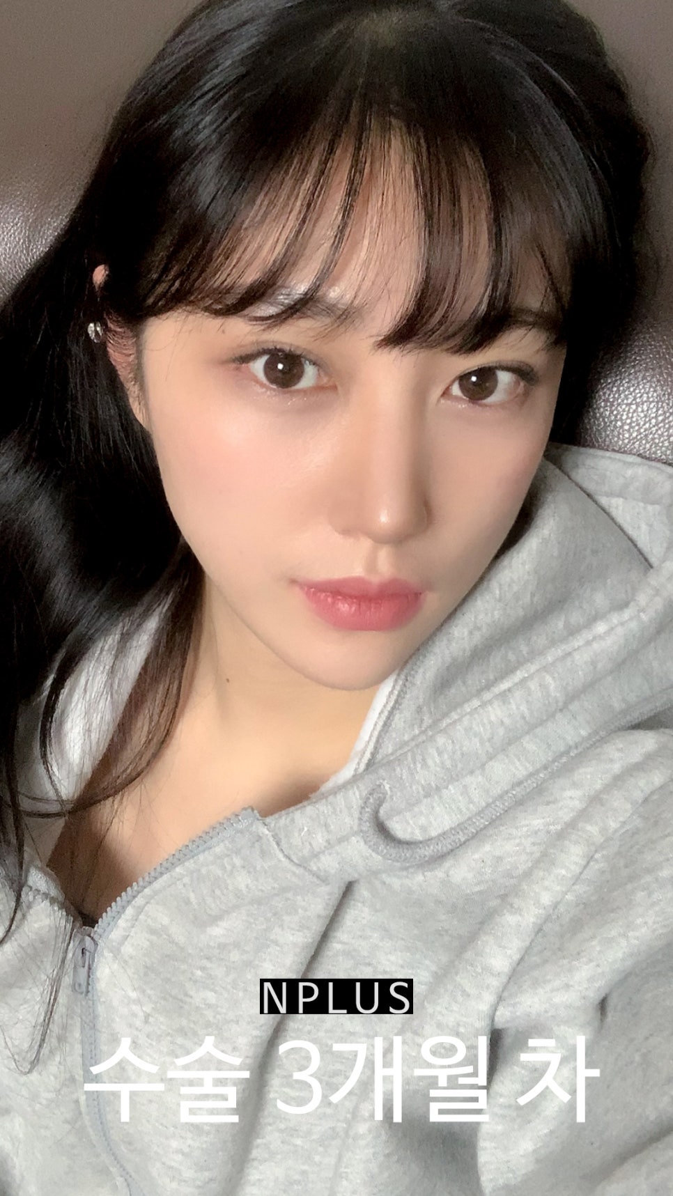 앤플러스에서 진행된 매부리코성형후기 관련 이미지 9