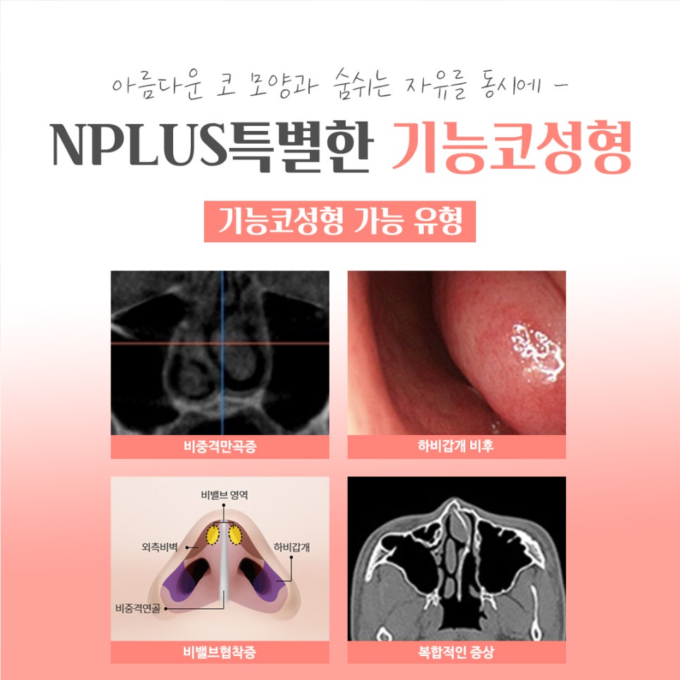 기능코성형후기 여러 가지를 비교하고 관련 이미지 5