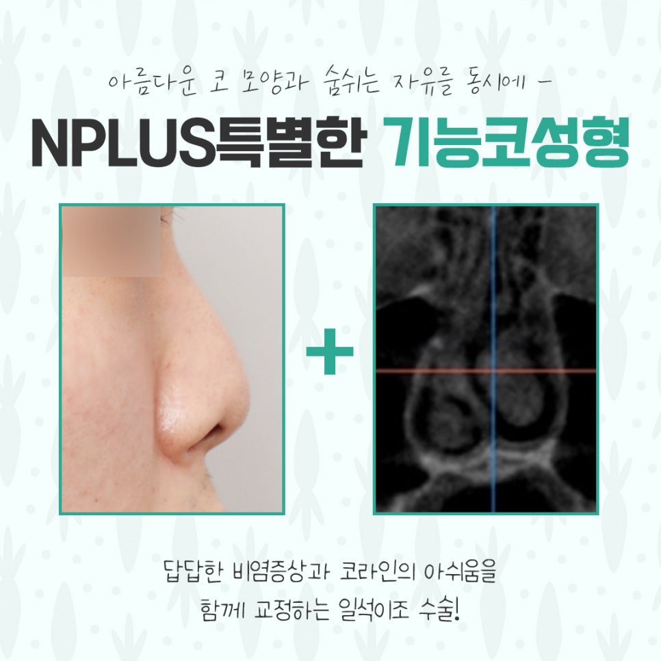 기능코수술후기 다양하게 고려하여 관련 이미지 3