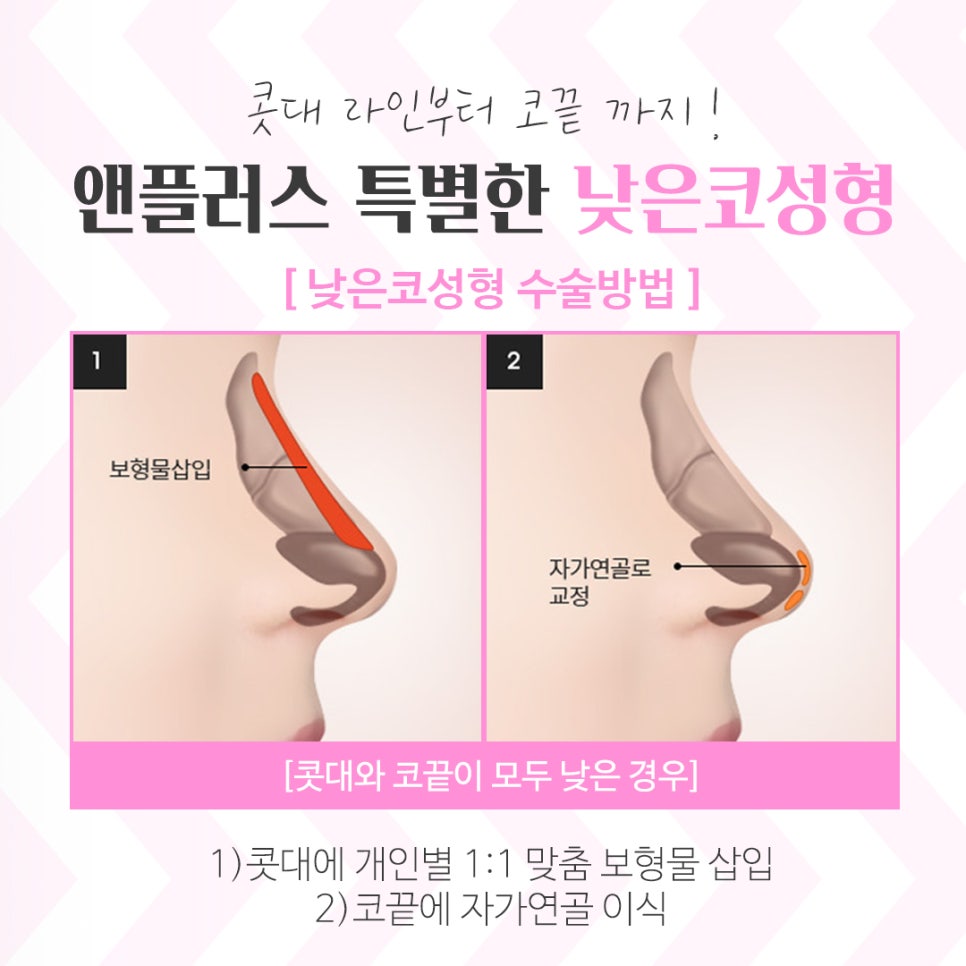 낮은코수술후기 확인하고 예쁜 라인으로 관련 이미지 7