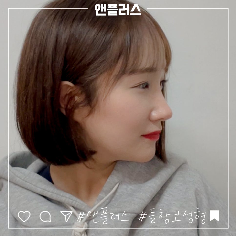 Carefully Checking Short Nose Surgery image 12
