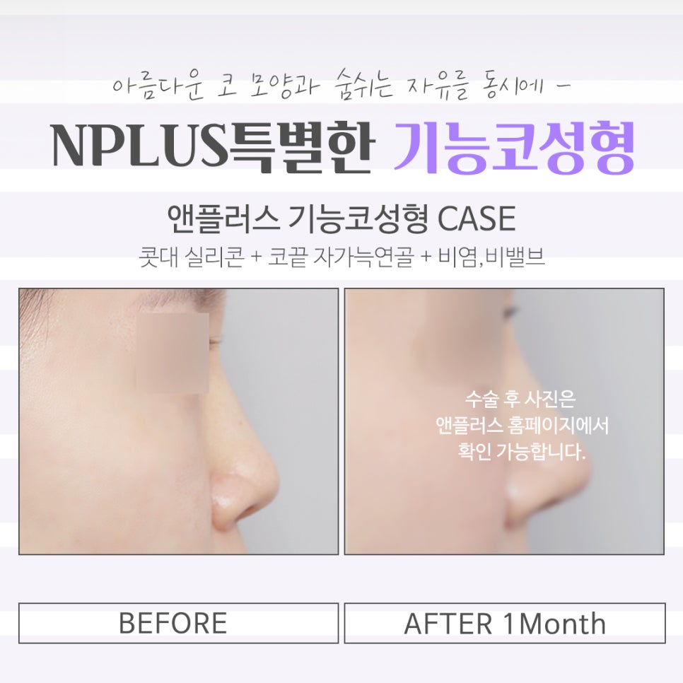 기능코성형후기 꼼꼼하게 체크하고 관련 이미지 15