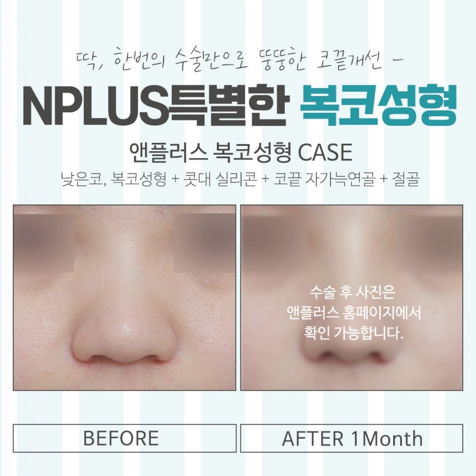 복코수술전후 확실한 차이를 알아보고 관련 이미지 15