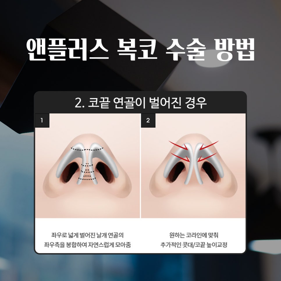 성형하기 힘든 코유형 관련 이미지 10