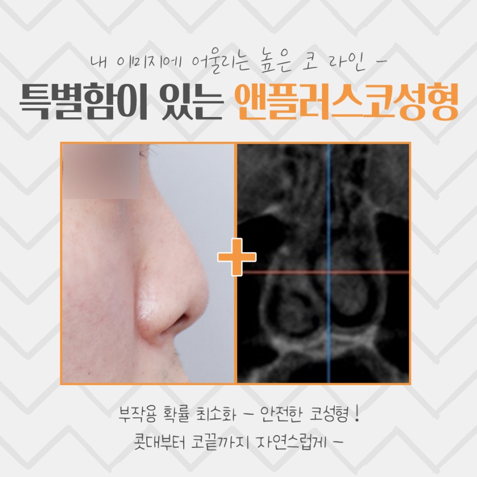 코성형후기 예쁘고 자연스러운 라인으로 관련 이미지 4