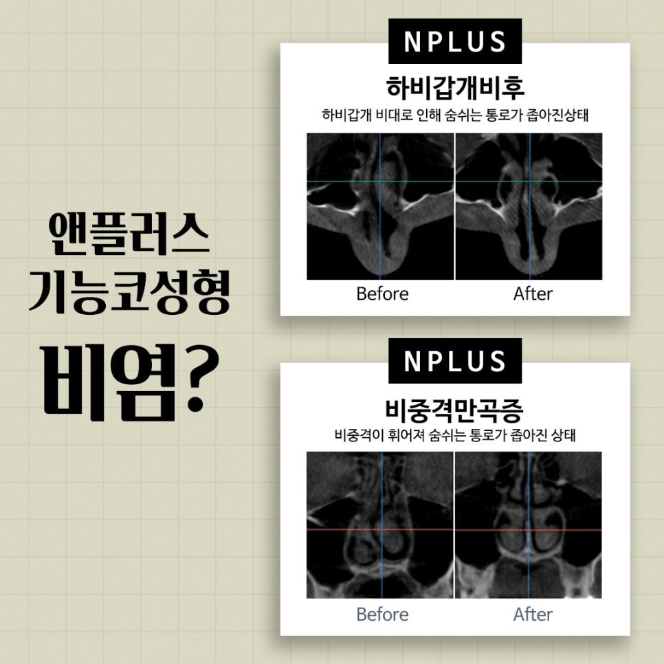 Carefully Learn About Functional Nose Surgery Coverage and Nose Reshaping image 4