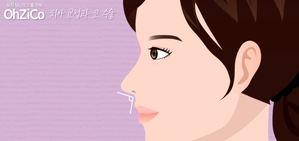 비순각수술 자연스럽고 예쁘게 관련 이미지 9