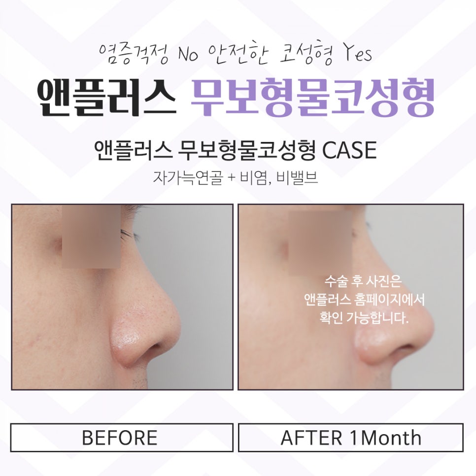 Learn More in Detail About Reviews of Nose Surgery Without Implants image 6